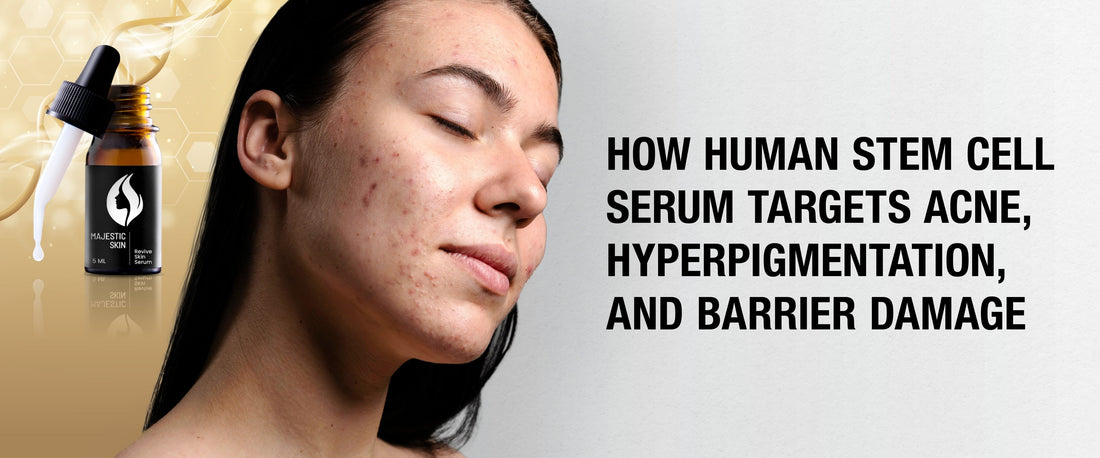 Majestic Skin Human Stem Cell Serum – Clinical-Level Treatment for Acne, Hyperpigmentation, and Barrier Repair